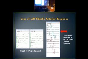 S3P-2017-Adult Nerve Root Monitoring
