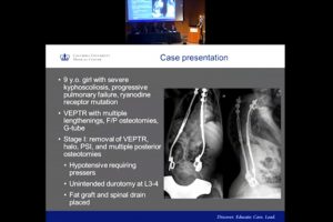S3P-2017-CSF Leaks in Spinal Surgery