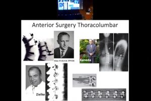 Paper 1: Evolution of surgery for adolescent idiopathic scoliosis