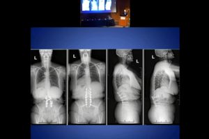 Quantifying preop risk in spine surgery: Risk severity scores