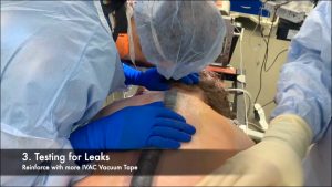 IVAC for Neuromuscular Scoliosis Surgery