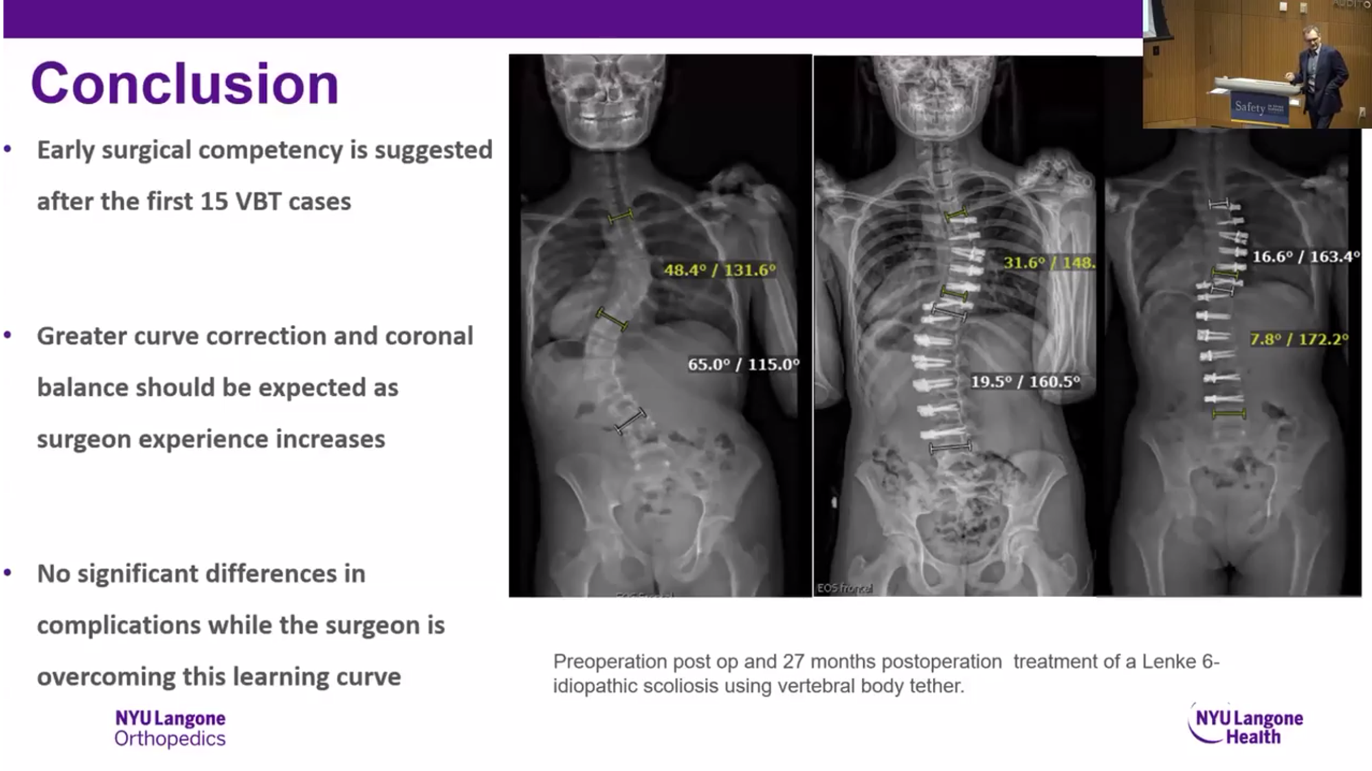 Assessing the Learning Curve of Vertebral Body Tethering in Idiopathic Scoliosis: A Multicenter Analysis