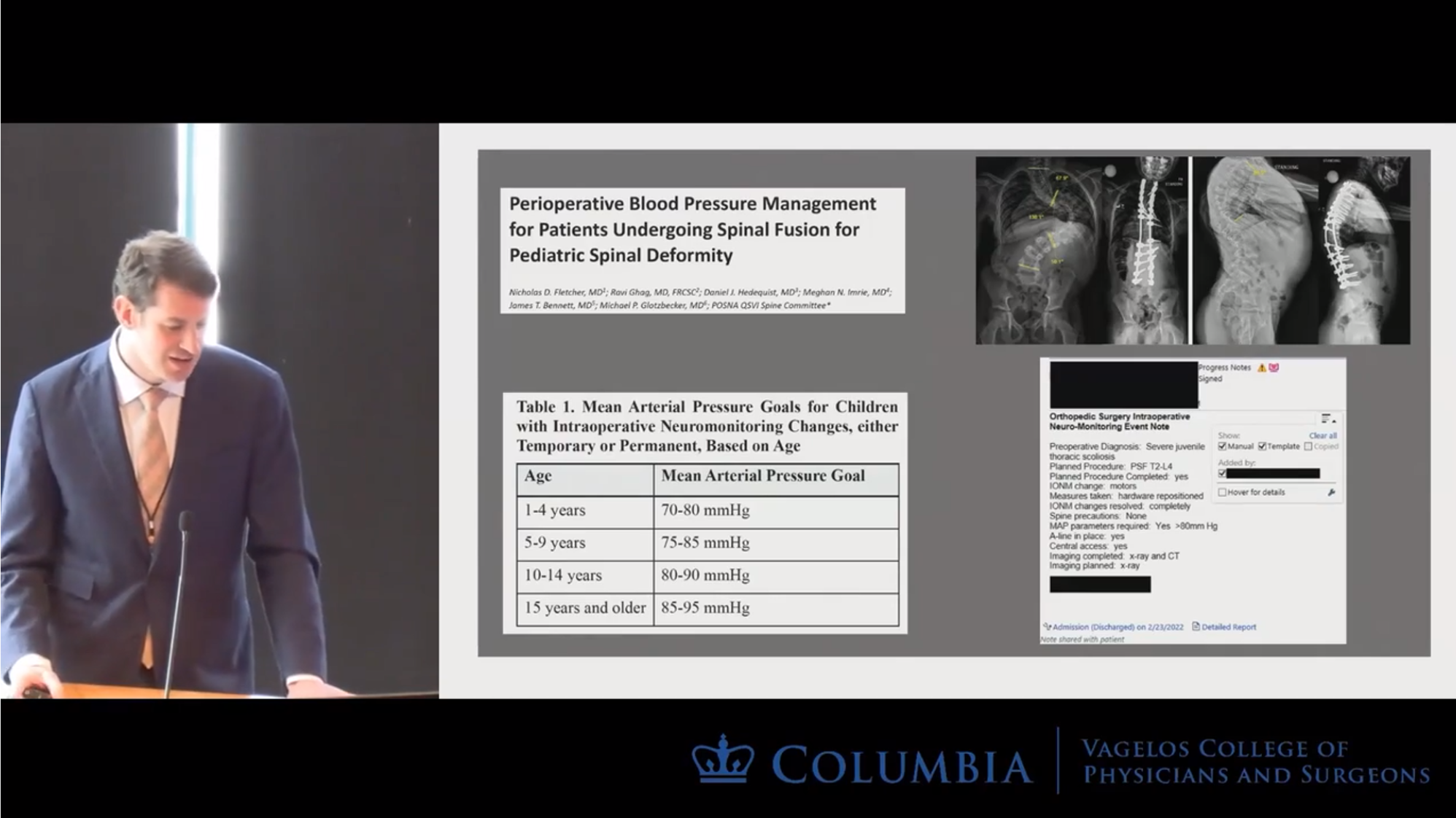 Delayed Onset Neurologic Deficit Following Spinal Fusion for Pediatric Spinal Deformity