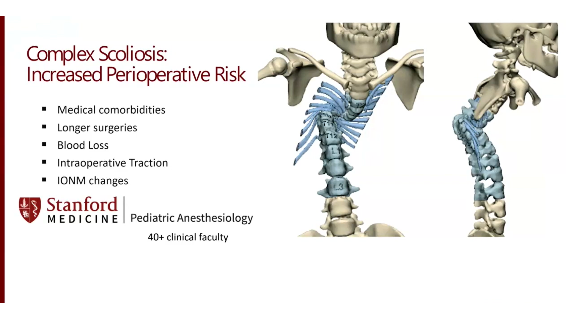 Designated Spine Anesthesia Teams Improve Perioperative Outcomes for Complex Scoliosis