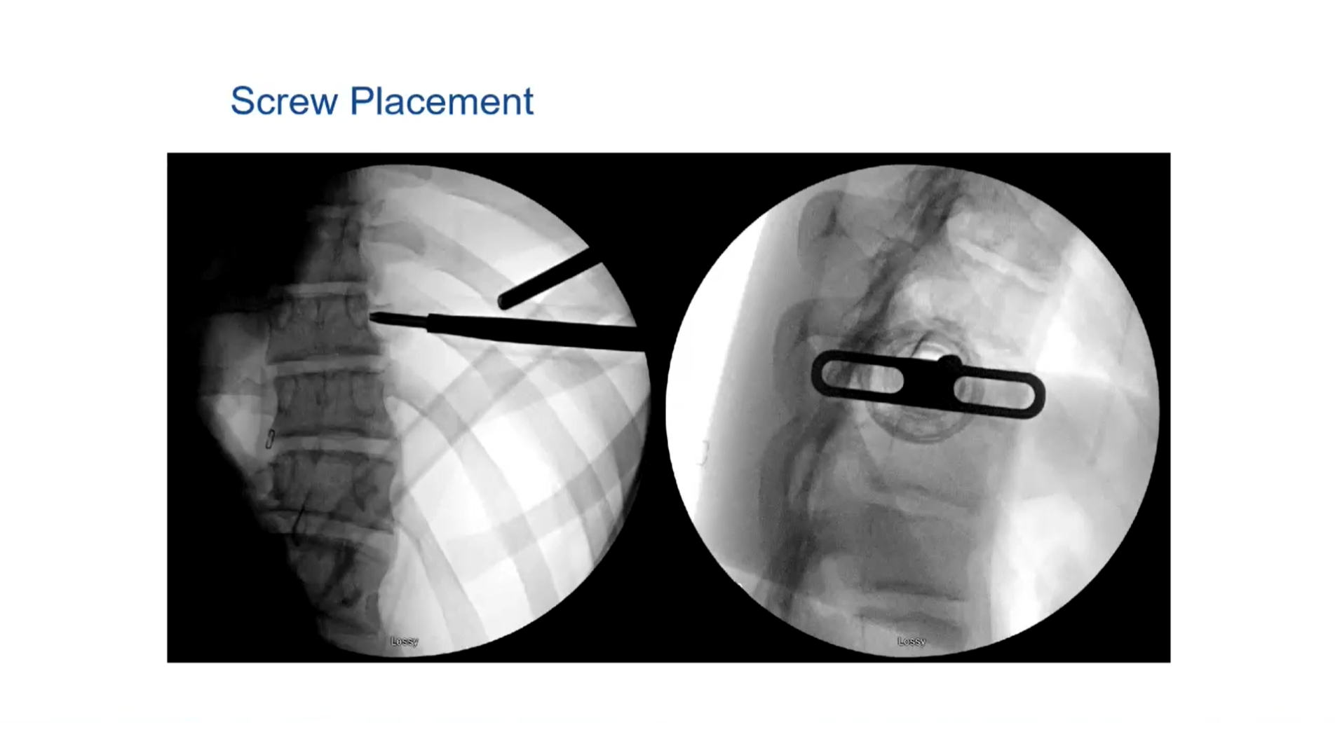 Staying Out of Trouble in Vertebral Body Tethering